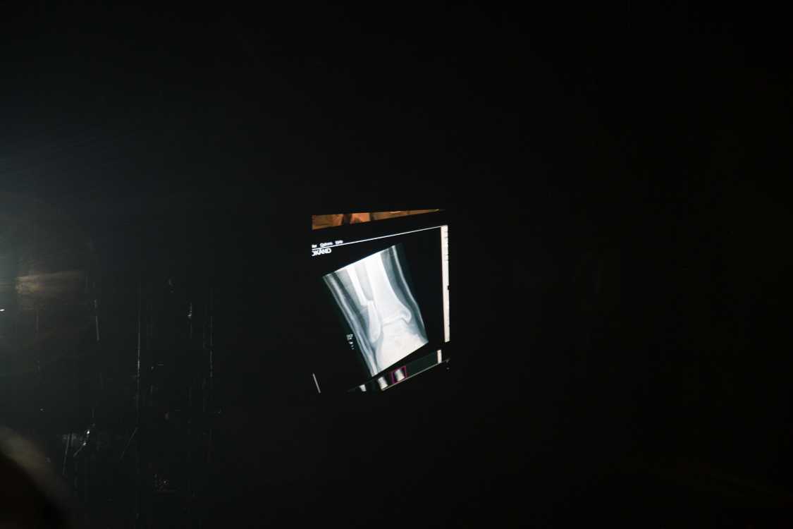 途中で骨折のいきさつを説明。骨折事故を演出として見せ場にしてしまうのはさすが一流のアーティストだ。